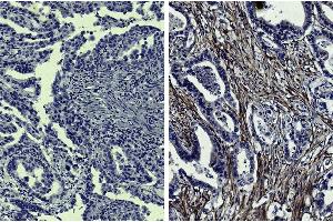 Paraffin embedded human gastric cancer tissue was stained with Mouse IgG1-UNLB isotype control followed by HRP conjugated Anti-Mouse Ig secondary antibody, DAB, and hematoxylin. (MMP2 antibody  (HRP))