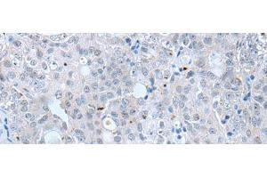 Immunohistochemistry of paraffin-embedded Human ovarian cancer tissue using CLDN12 Polyclonal Antibody at dilution of 1:45(x200)