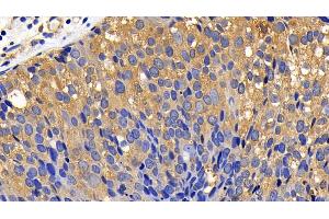 Detection of BCL2L11 in Human Breast cancer Tissue using Polyclonal Antibody to Bcl2 Like Protein 11 (BCL2L11) (BIM antibody  (AA 2-120))
