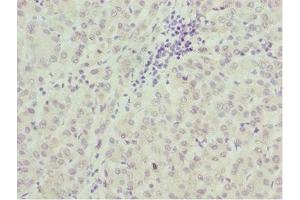 Immunohistochemistry of paraffin-embedded human liver cancer using ABIN7172689 at dilution of 1:100 (TAF5 antibody  (AA 656-800))