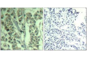 Immunohistochemical analysis of paraffin-embedded human breast carcinoma tissue using c-Cbl(Phospho-Tyr700) Antibody(left) or the same antibody preincubated with blocking peptide(right). (CBL antibody  (pTyr770))