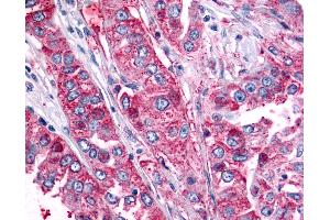 Anti-BAI2 antibody IHC of human Lung, Non-Small Cell Carcinoma. (BAI2 antibody  (C-Term))