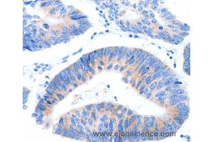 Immunohistochemistry of Human lung cancer using MUC3A Polyclonal Antibody at dilution of 1:60 (MUC3A antibody)
