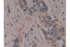 Detection of CYP27B1 in Human Breast cancer Tissue using Polyclonal Antibody to Cytochrome P450 27B1 (CYP27B1) (CYP27B1 antibody  (AA 256-508))