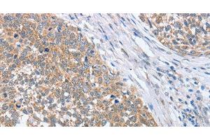 Immunohistochemistry of paraffin-embedded Human cervical cancer tissue using PAPSS1 Polyclonal Antibody at dilution 1:40 (PAPSS1 antibody)