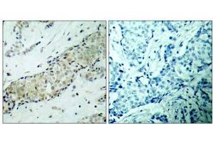 Immunohistochemical analysis of paraffin- embedded human breast carcinoma tissue, using HDAC5 (Ab-498) Antibody (E021142). (HDAC5 antibody)