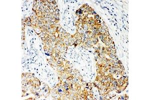 IHC-P: NOX5 antibody testing of human breast cancer tissue (NOX5 antibody  (C-Term))