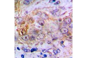 Immunohistochemical analysis of Carbonic Anhydrase 2 staining in human lung cancer formalin fixed paraffin embedded tissue section. (CA2 antibody  (C-Term))