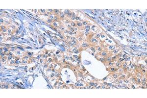 Immunohistochemistry of paraffin-embedded Human cervical cancer using INHBC Polyclonal Antibody at dilution of 1:50 (INHBC antibody)