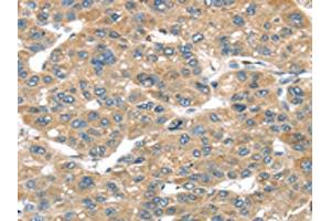 The image on the left is immunohistochemistry of paraffin-embedded Human liver cancer tissue using ABIN7192958(TUSC1 Antibody) at dilution 1/45, on the right is treated with synthetic peptide. (TUSC1 antibody)