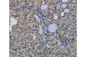 Immunohistochemistry of Human thyroid cancer using GYS1 Polyclonal Antibody at dilution of 1:50 (Glycogen Synthase 1 antibody)