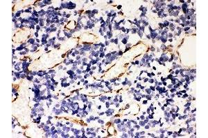 IHC-P: HSP47 antibody testing of human lung cancer tissue (SERPINH1 antibody  (AA 247-418))