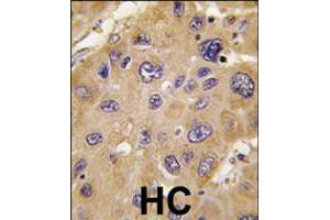 Formalin-fixed and paraffin-embedded human hepatocarcinoma tissue reacted with *ALDH6A1 antibody , which was peroxidase-conjugated to the secondary antibody, followed by DAB staining.
