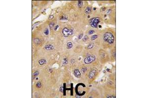 Formalin-fixed and paraffin-embedded human hepatocarcinoma tissue reacted with *ALDH6A1 antibody , which was peroxidase-conjugated to the secondary antibody, followed by DAB staining. (ALDH6A1 antibody  (C-Term))
