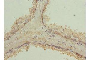 Immunohistochemistry of paraffin-embedded human prostate cancer using ABIN7167389 at dilution of 1:100 (RAB9A antibody  (AA 122-201))