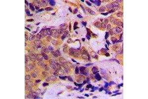 Immunohistochemical analysis of DOK1 staining in human breast cancer formalin fixed paraffin embedded tissue section. (DOK1 antibody)