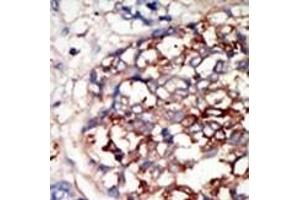 Formalin-fixed and paraffin-embedded human cancer tissue reacted with the primary antibody, which was peroxidase-conjugated to the secondary antibody, followed by DAB staining. (DYRK1B antibody  (C-Term))