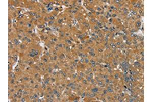 The image on the left is immunohistochemistry of paraffin-embedded Human liver cancer tissue using ABIN7192302(SEMA6D Antibody) at dilution 1/25, on the right is treated with synthetic peptide. (SEMA6D antibody)