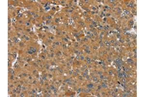 The image on the left is immunohistochemistry of paraffin-embedded Human liver cancer tissue using ABIN7192302(SEMA6D Antibody) at dilution 1/25, on the right is treated with synthetic peptide. (SEMA6D antibody)