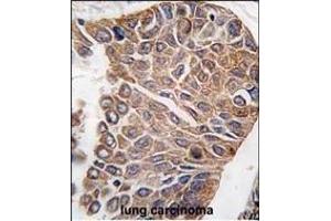 Formalin-fixed and paraffin-embedded human lung carcinoma tissue reacted with AKT2 antibody (C-term), which was peroxidase-conjugated to the secondary antibody, followed by DAB staining.