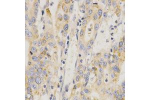 Immunohistochemistry of paraffin-embedded human stomach cancer using MAP2K6 antibody at dilution of 1:200 (x400 lens)