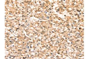 The image on the left is immunohistochemistry of paraffin-embedded Human prostate cancer tissue using ABIN7192443(SLC25A38 Antibody) at dilution 1/20, on the right is treated with synthetic peptide. (SLC25A38 antibody)