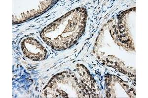 Immunohistochemical staining of paraffin-embedded Adenocarcinoma of ovary tissue N93ing anti-CYP1A2 mouse monoclonal antibody. (CYP1A2 antibody)