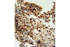 INDO antibody (Center) (ABIN650713 and ABIN2839358) immunohistochemistry analysis in formalin fixed and paraffin embedded human lung carcinoma followed by peroxidase conjugation of the secondary antibody and DAB staining. (IDO1 antibody  (AA 79-105))