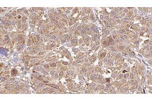 ABIN6276505 at 1/100 staining Human Melanoma tissue by IHC-P. (C19orf10 antibody)