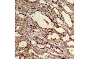 Immunohistochemical analysis of AKT1 staining in human breast cancer formalin fixed paraffin embedded tissue section. (AKT1 antibody)