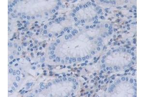 Detection of RNASEL in Human Stomach cancer Tissue using Polyclonal Antibody to Ribonuclease L (RNASEL) (RNASEL antibody  (AA 358-583))