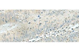 Immunohistochemistry of paraffin-embedded Human colorectal cancer tissue using DENND6A Polyclonal Antibody at dilution of 1:120(x200) (FAM116A antibody)