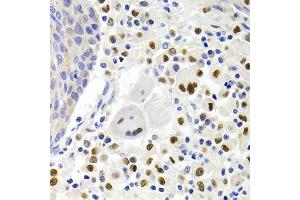 Immunohistochemistry of paraffin-embedded human lung cancer using GEMIN2 Antibody (ABIN1872798) at dilution of 1:200 (40x lens). (SIP1 antibody)