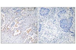Immunohistochemistry analysis of paraffin-embedded human lung carcinoma tissue using GNB5 antibody. (GNB5 antibody  (Internal Region))