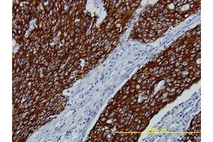 Immunoperoxidase of monoclonal antibody to FGFR2 on formalin-fixed paraffin-embedded human stomach carcinoma tissue. (FGFR2 antibody  (AA 621-723))