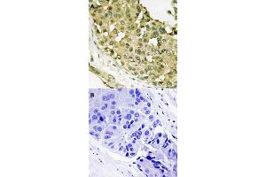 Immunohistochemical staining (Formalin-fixed paraffin-embedded sections) of human breast cancer tissue with STMN1 (phospho S63) polyclonal antibody  without blocking peptide (A) or preincubated with blocking peptide (B) under 1:50-1:100 dilution. (Stathmin 1 antibody  (pSer63))