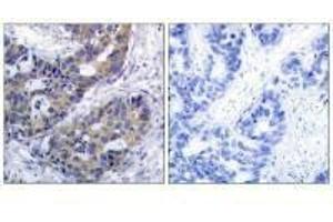 Immunohistochemistry analysis of paraffin-embedded human breast carcinoma tissue, using IRS-1 (Ab-312) antibody. (IRS1 antibody  (Ser312))