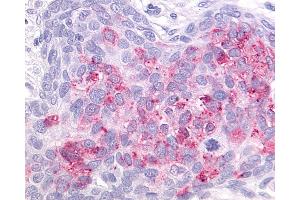 Anti-GPR55 antibody IHC of human Ovary, Carcinoma. (GPR55 antibody  (C-Term))