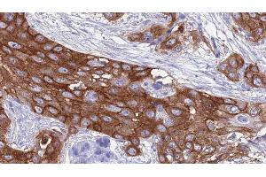 ABIN6277405 at 1/100 staining Human Head and neck cancer tissue by IHC-P. (ABCC5 antibody  (N-Term))