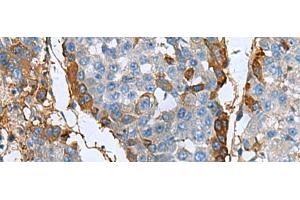 Immunohistochemistry of paraffin-embedded Human liver cancer tissue using TGFBI Polyclonal Antibody at dilution of 1:60(x200) (TGFBI antibody)