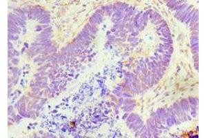 Immunohistochemistry of paraffin-embedded human ovarian cancer using ABIN7154549 at dilution of 1:100