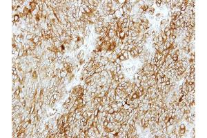 IHC-P Image Immunohistochemical analysis of paraffin-embedded DLD1 xenograft, using GMDS, antibody at 1:500 dilution. (GMDS antibody)