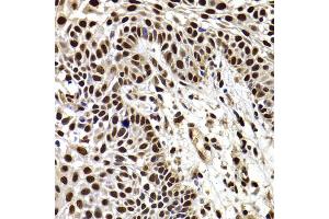 Immunohistochemistry of paraffin-embedded human well-differentiated squamous skin carcinoma using HIRIP3 antibody (ABIN2563051) at dilution of 1:100 (40x lens). (HIRIP3 antibody)