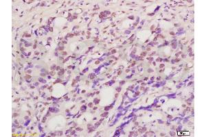 Paraformaldehyde-fixed, paraffin embedded Human colon cancer Antigen retrieval by boiling in sodium citrate buffer (pH6. (IFI16 antibody  (AA 201-350))