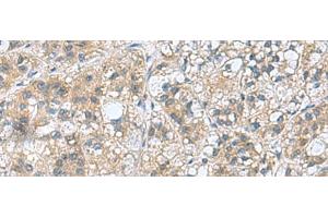 Immunohistochemistry of paraffin-embedded Human liver cancer tissue using RAB39A Polyclonal Antibody at dilution of 1:70(x200) (RAB39A antibody)
