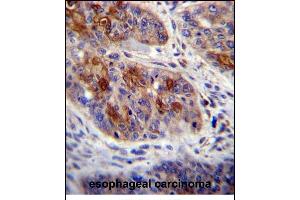 HAX1 Antibody (C-term) (ABIN656245 and ABIN2845562) immunohistochemistry analysis in formalin fixed and paraffin embedded human esophageal carcinoma followed by peroxidase conjugation of the secondary antibody and DAB staining. (HAX1 antibody  (C-Term))