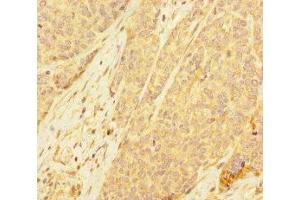 Immunohistochemistry of paraffin-embedded human ovarian cancer using ABIN7168417 at dilution of 1:100 (PDE6A antibody  (AA 656-860))