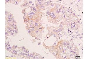 Formalin-fixed and paraffin embedded human colon carcinoma labeled with Anti-CD24 Polyclonal Antibody, Unconjugated  at 1:200, followed by conjugation to the secondary antibody and DAB staining (CD24 antibody  (AA 60-80))