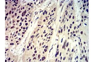 Immunohistochemical analysis of paraffin-embedded esophageal cancer tissues using Phospho-4E-BP1 (Ser65) mouse mAb with DAB staining.