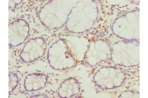 Immunohistochemistry of paraffin-embedded human colon cancer using ABIN7167630 at dilution of 1:100 (FAM82B antibody  (AA 13-314))